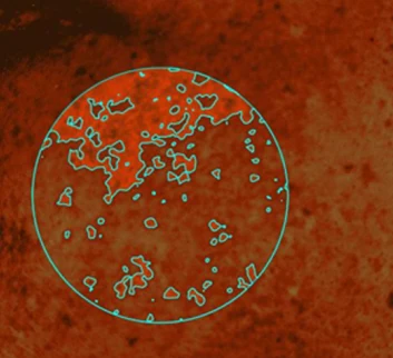 Skin image of a cheek before using the serum, with dark spots outlined
